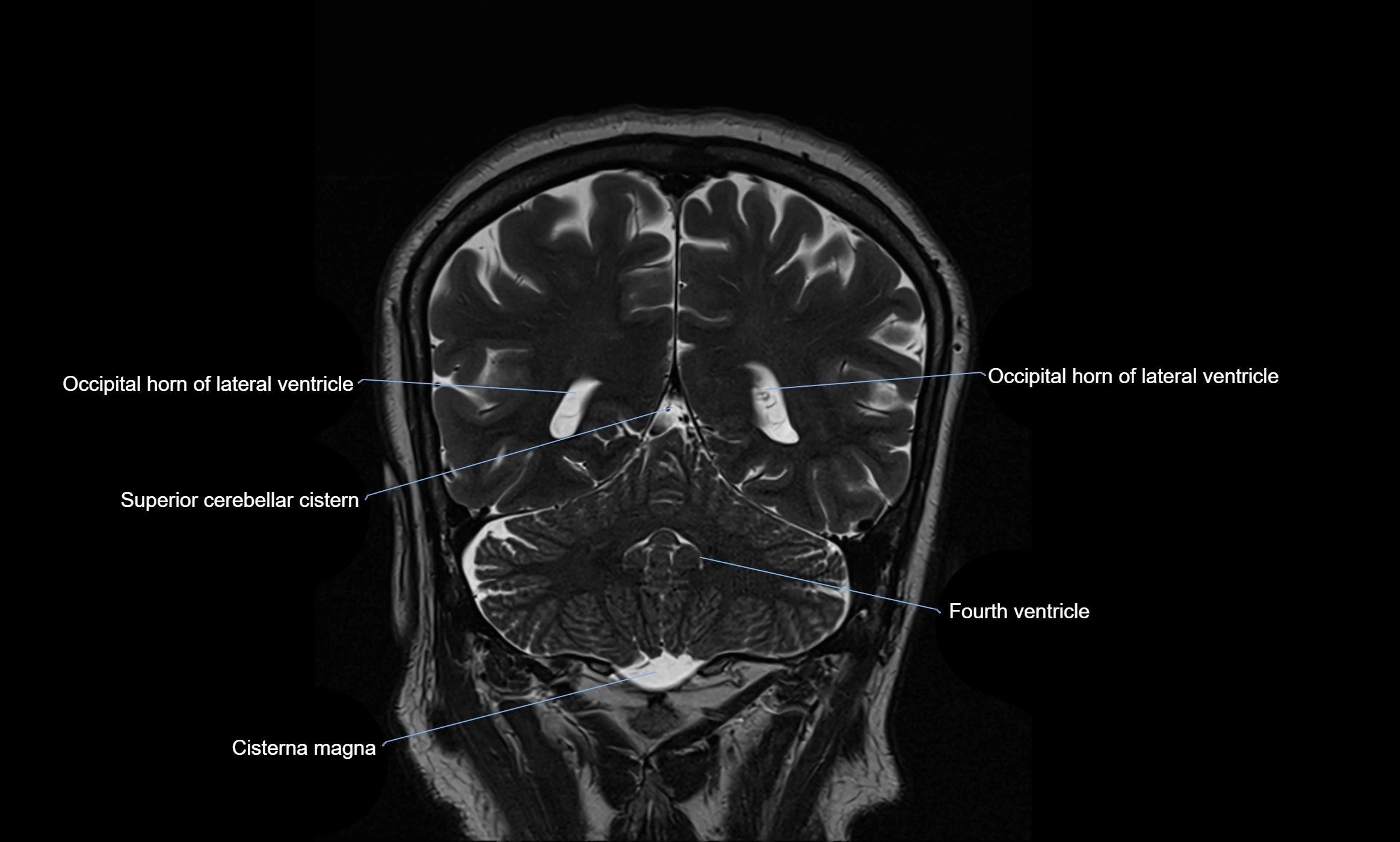 Brain cisterns  and ventricles coronal anatomy 3T MRI image-img-00001-00044.webp
